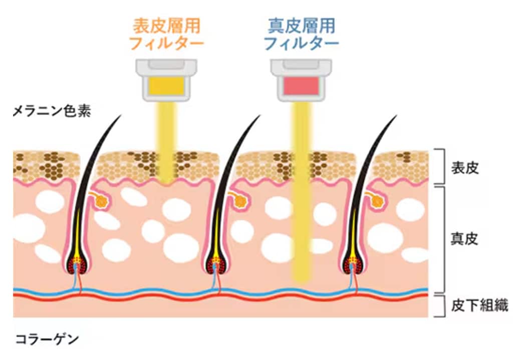 IPL光治療とは？