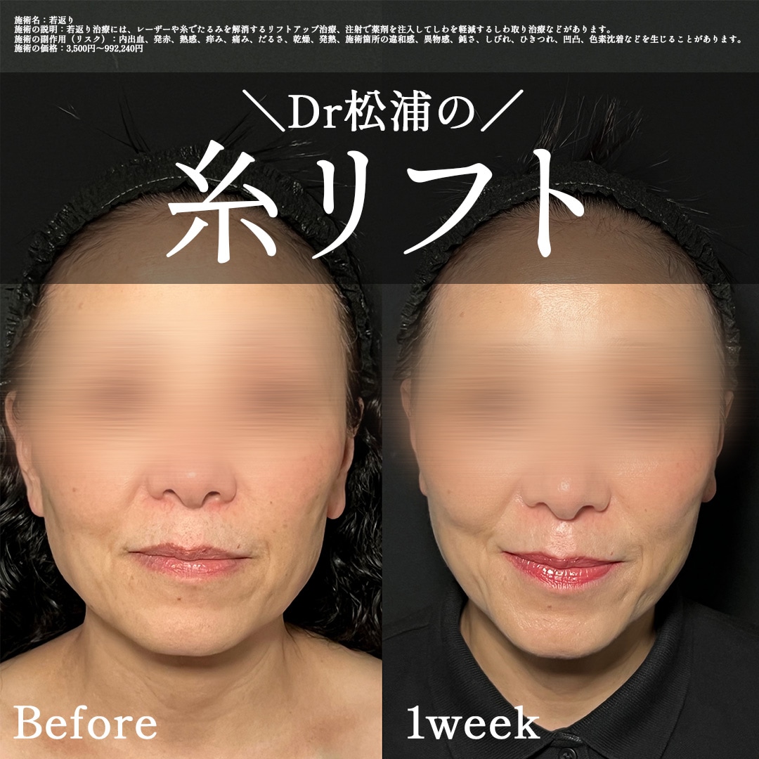 もたつき改善✨フェイスラインがシャープに✨