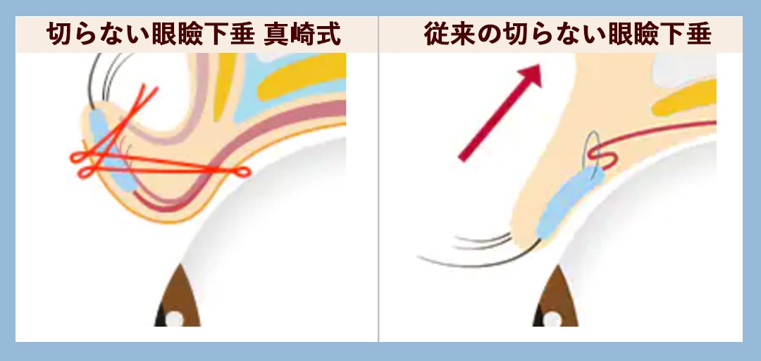 従来の術式より、持続性とデザイン性がUPしました！