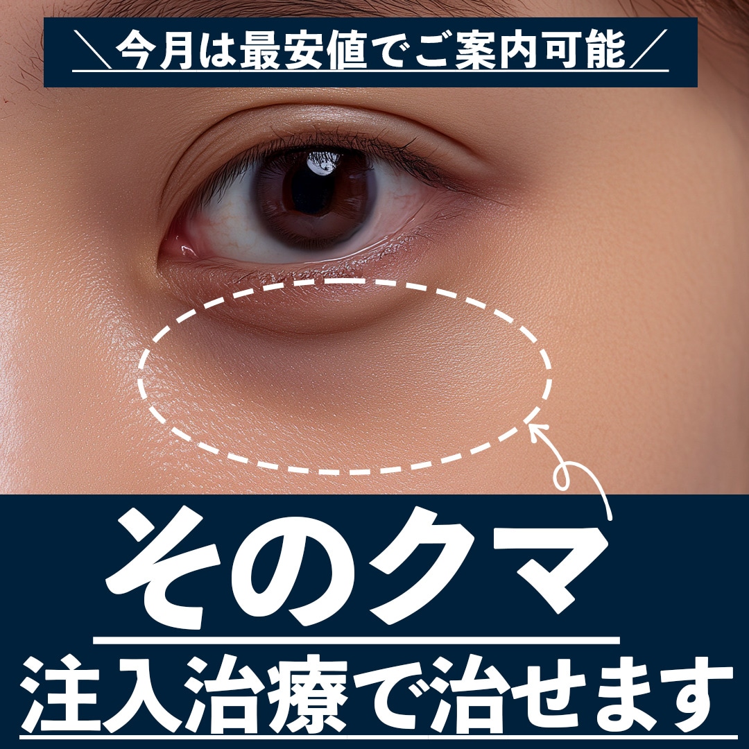 【注入治療でクマ取り】外科手術に抵抗がある方必見！ベビーコラーゲン(ヒューマラジェン)注入でクマ解消！_埼玉で若返り治療をするなら湘南美容クリニック所沢院