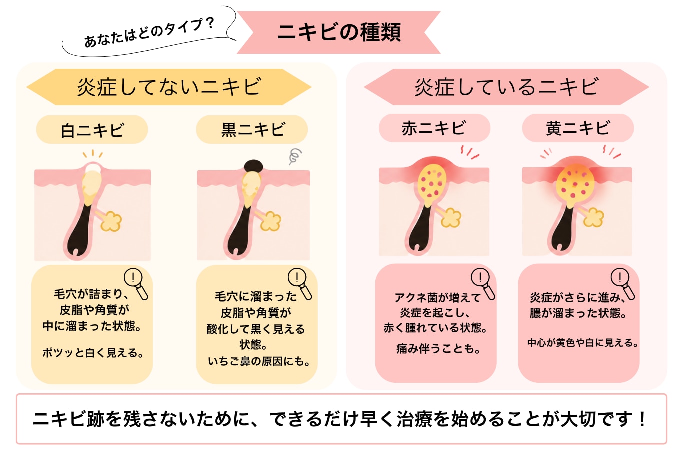 あなたのニキビはどのタイプ？