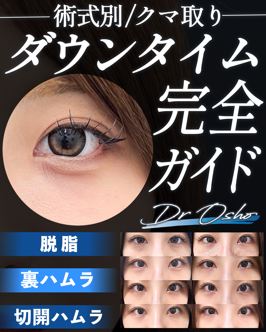 【クマ取りダウンタイム】実際どのくらい腫れるの？術式の違いは？経過を新院長本多正旺医師が徹底解説！_埼玉でクマ取りをするなら湘南美容クリニック所沢院