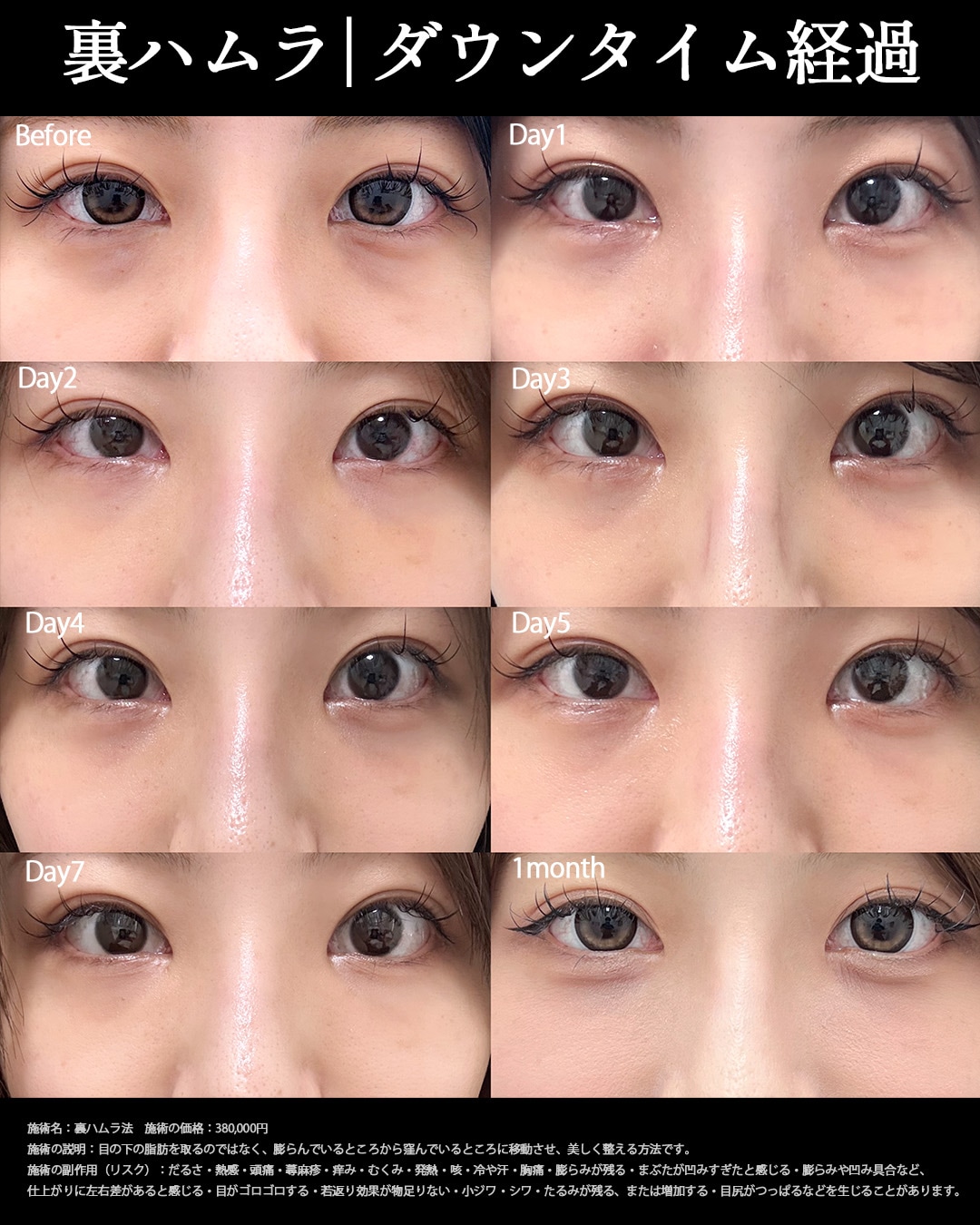20代女性の裏ハムラ症例