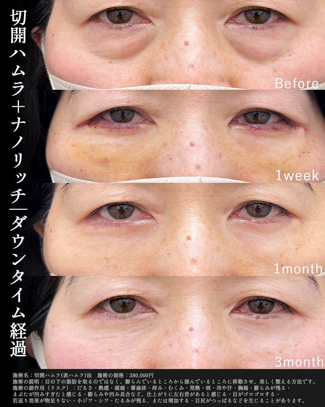 50代女性の切開ハムラの症例