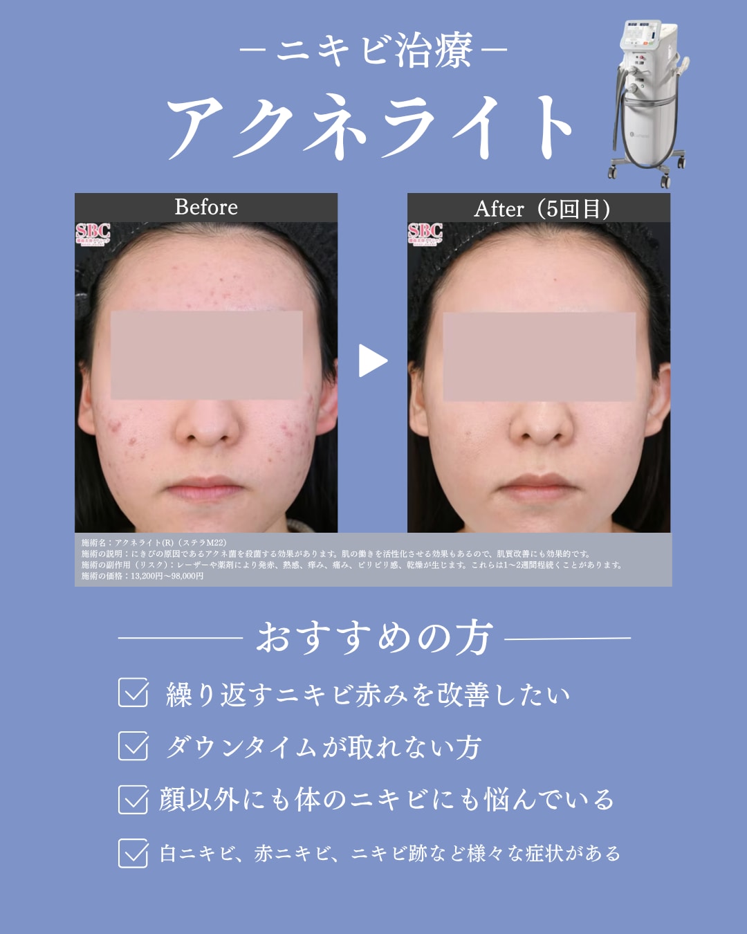 炎症している赤ニキビ・黄ニキビがある方