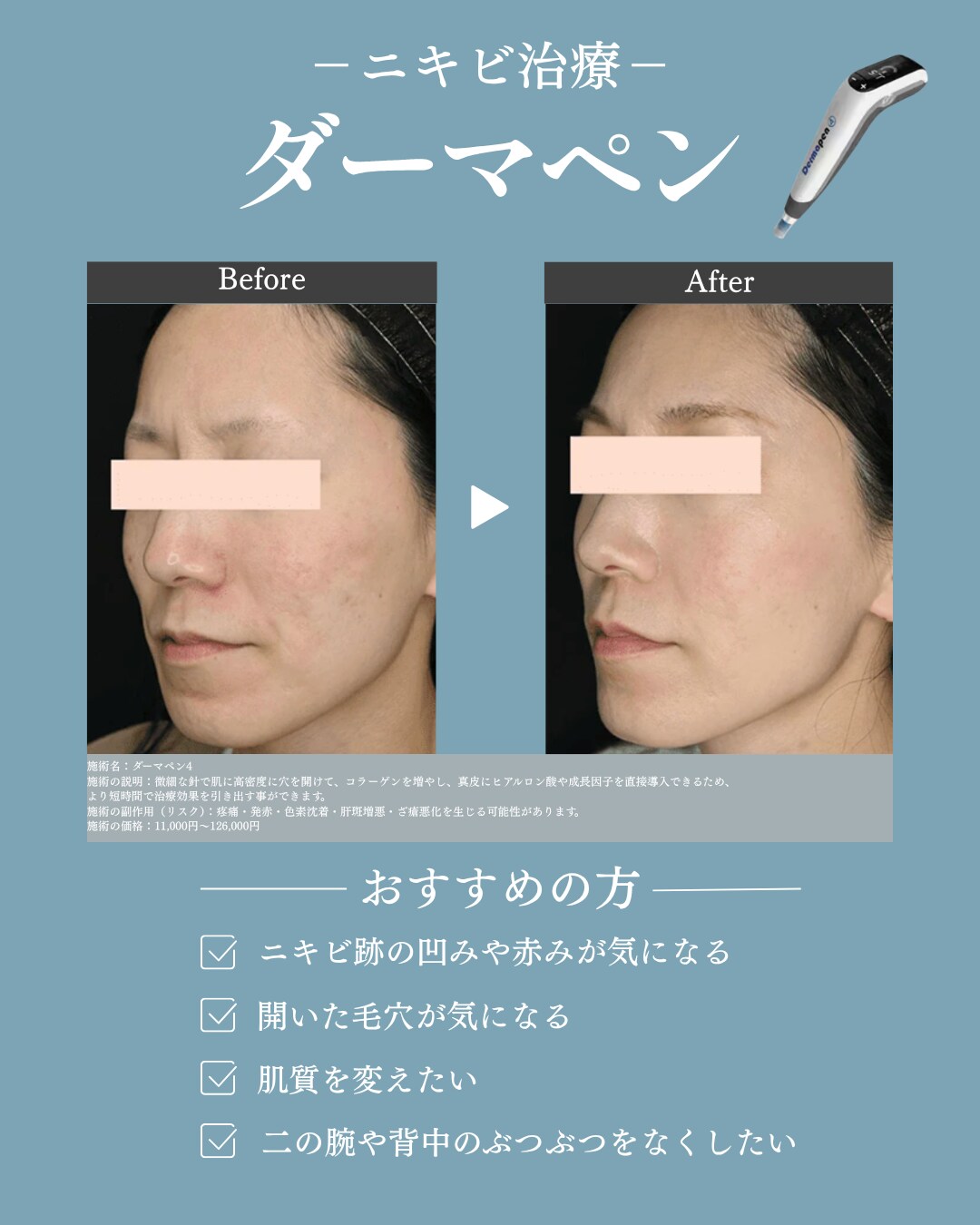 ニキビ跡・毛穴にお困りの方<br />
