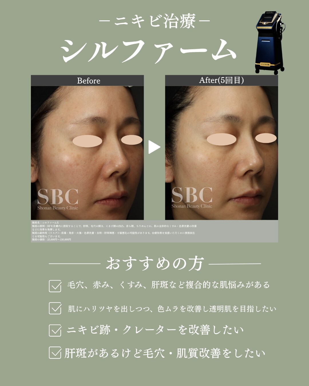 炎症していない【白ニキビ・黒ニキビ】がある方