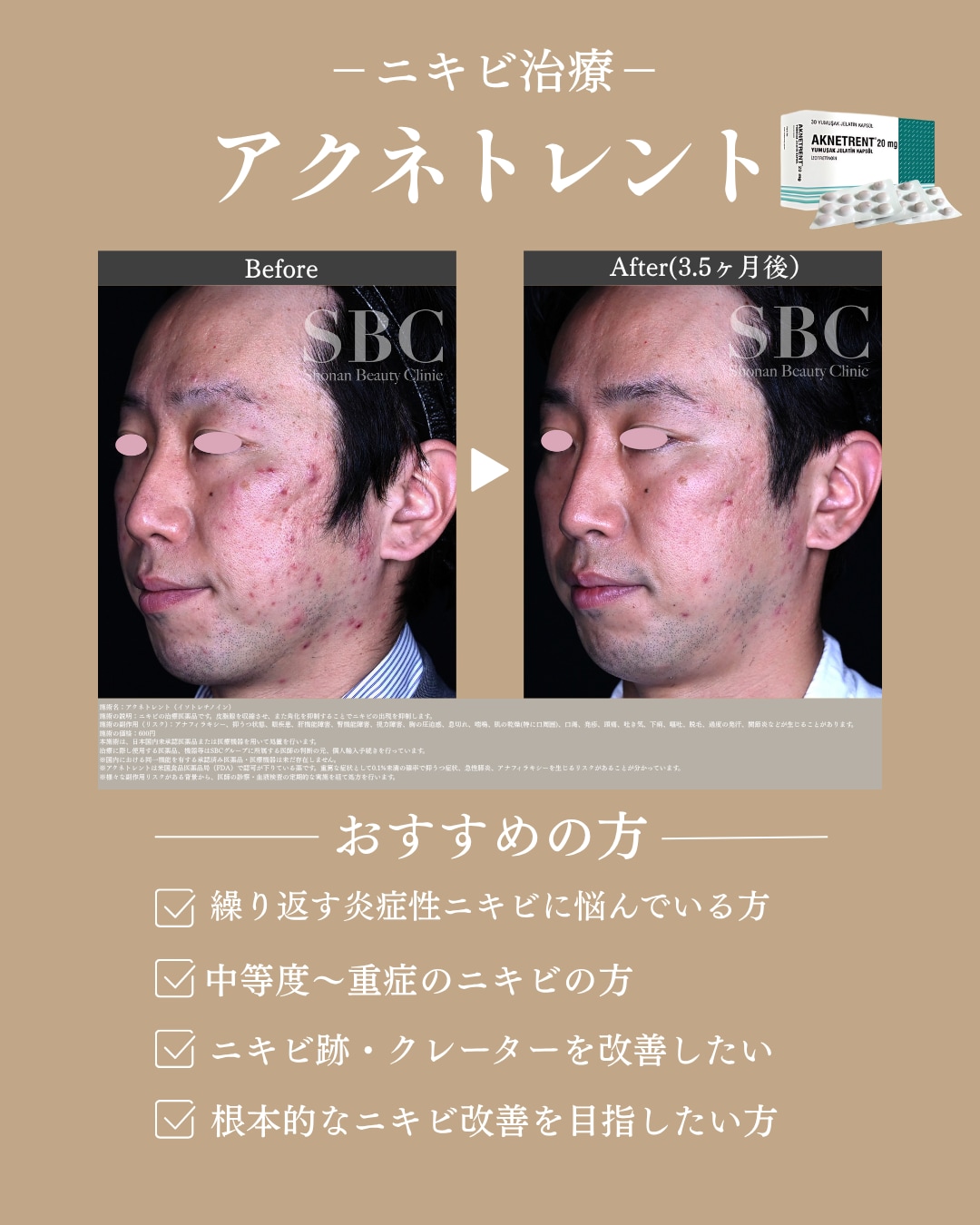 重症ニキビ・ニキビ跡の方
