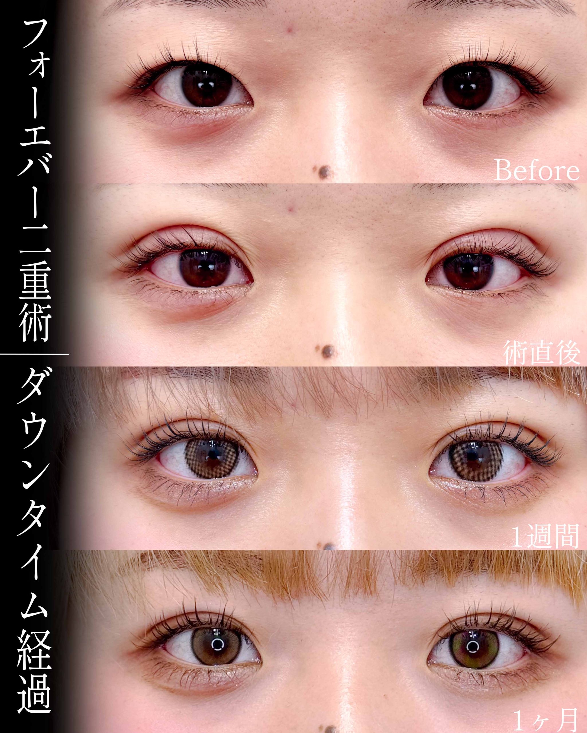 フォーエバー二重術(旧線留めクロス二重術)症例