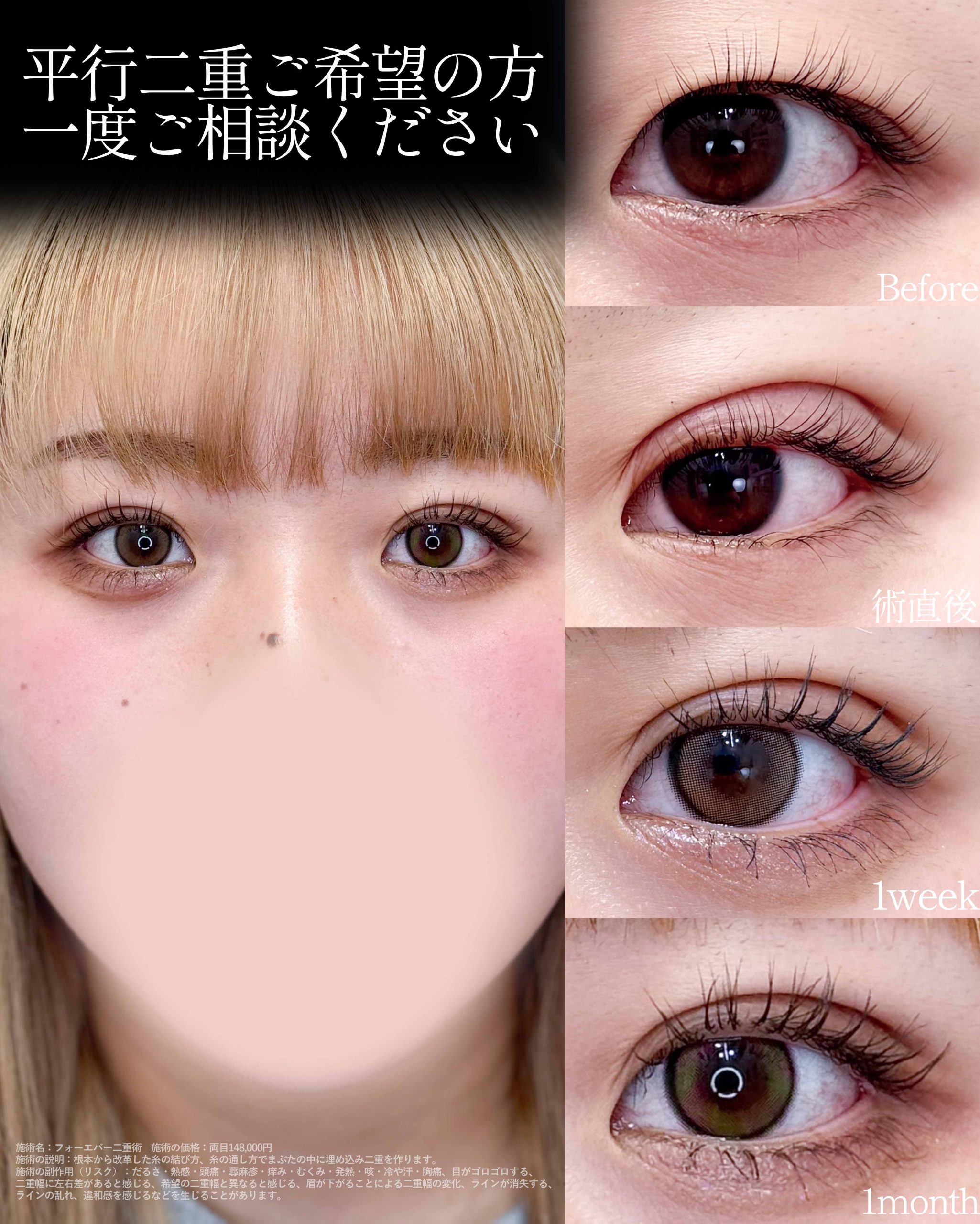 平行型二重をご希望の方へ