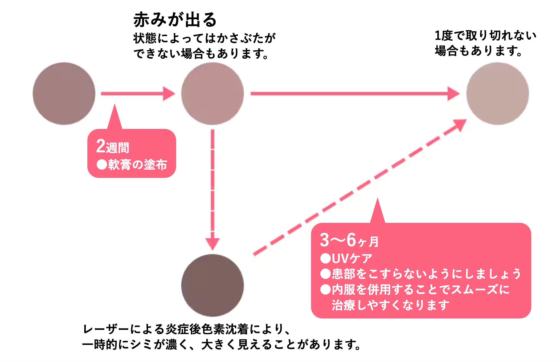 シミ取り治療「ピコスポット」