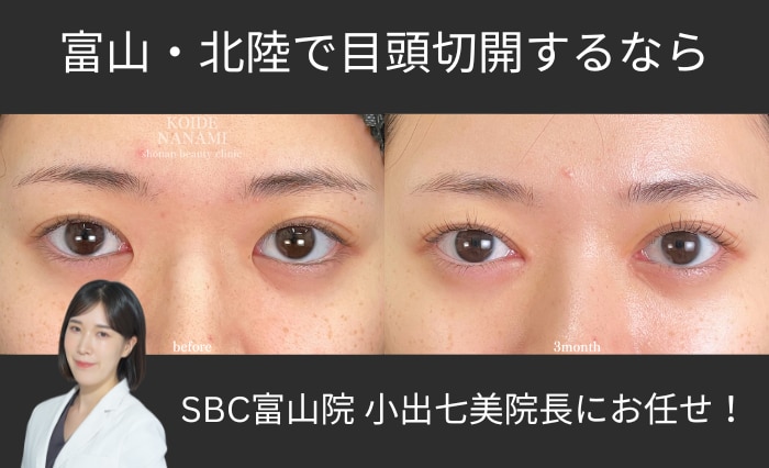 富山・北陸で目頭切開 湘南美容クリニック富山院