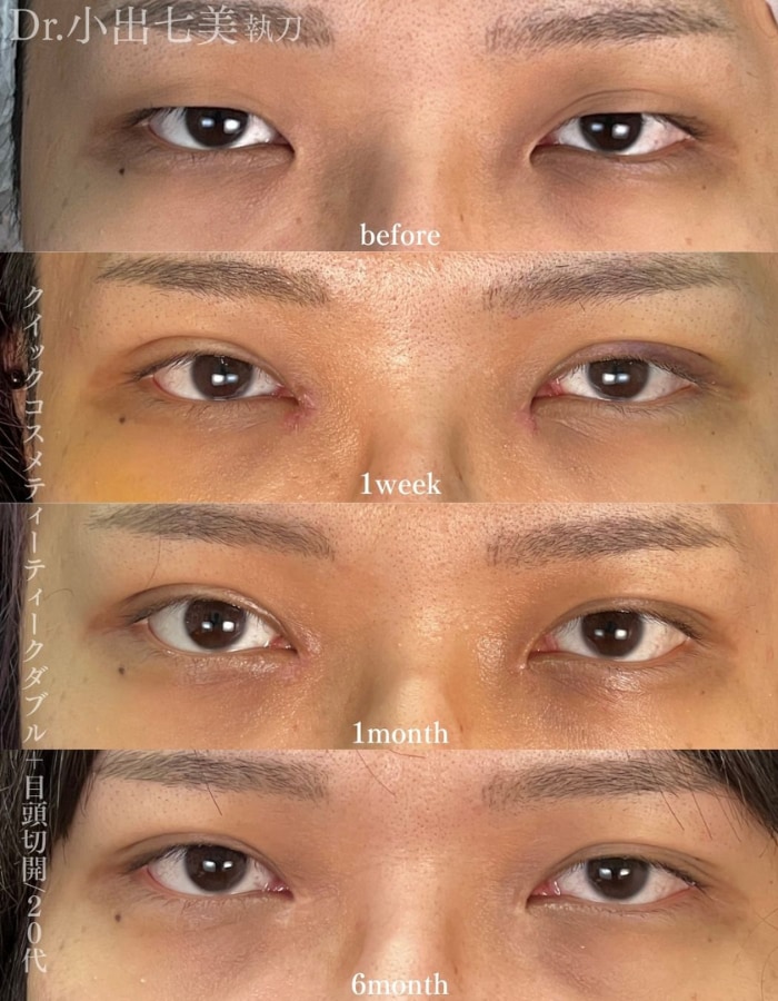 埋没との併用がオススメな理由