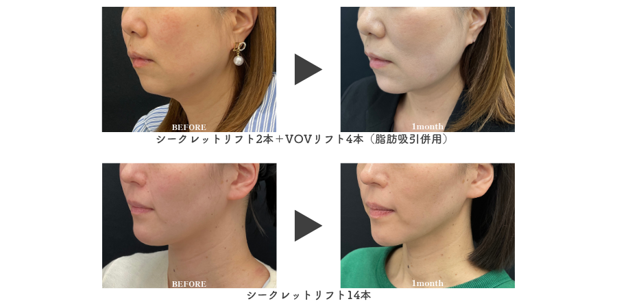 糸リフト症例<br />