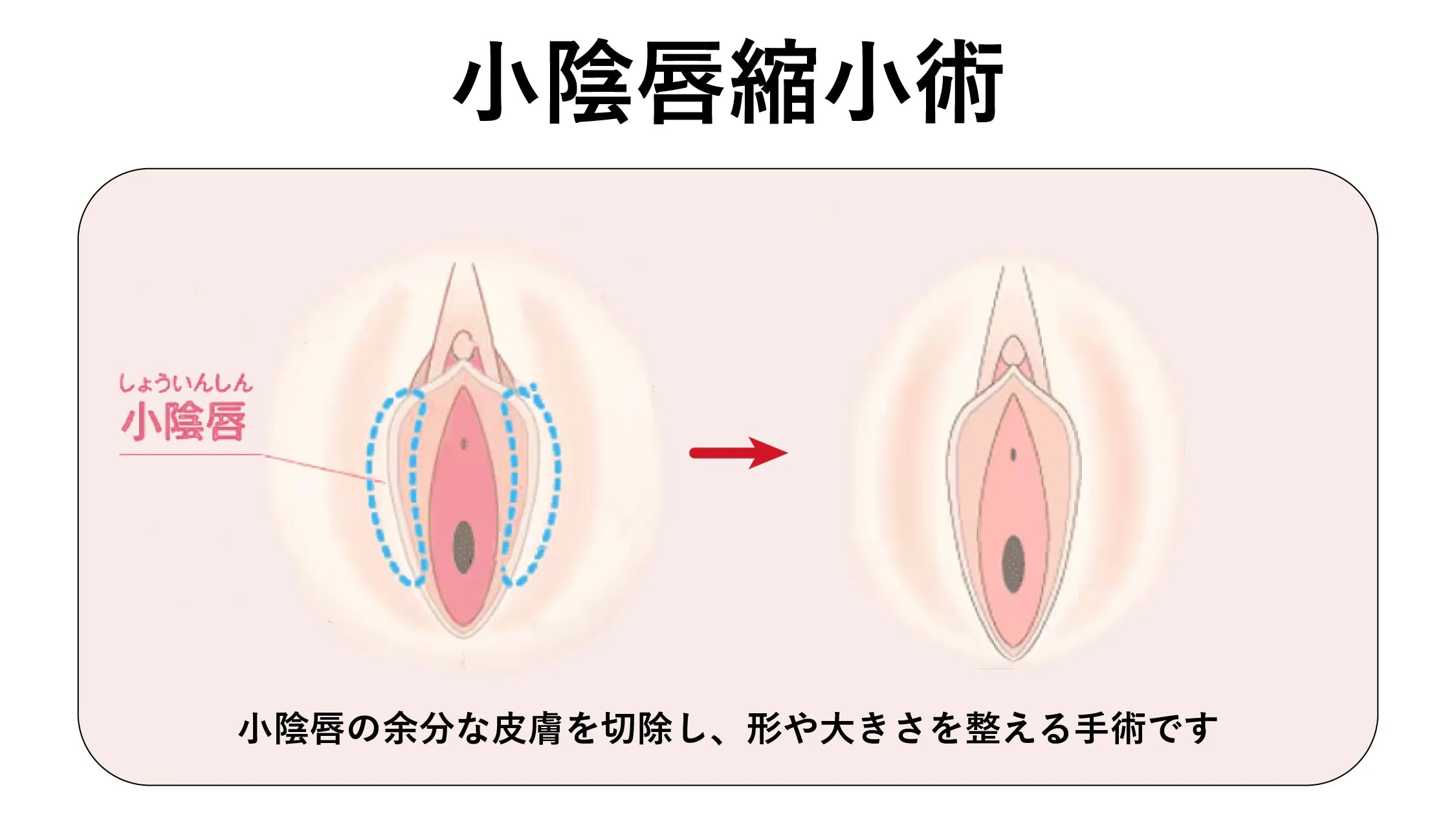 小陰唇縮小術