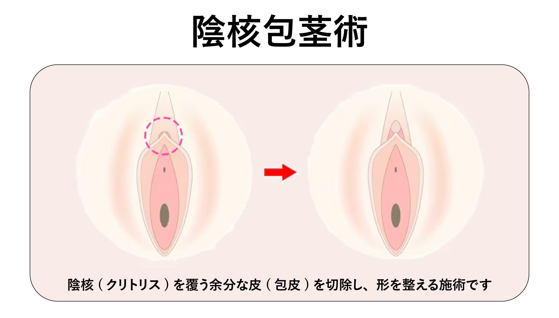 陰核包茎（クリトリス包茎）