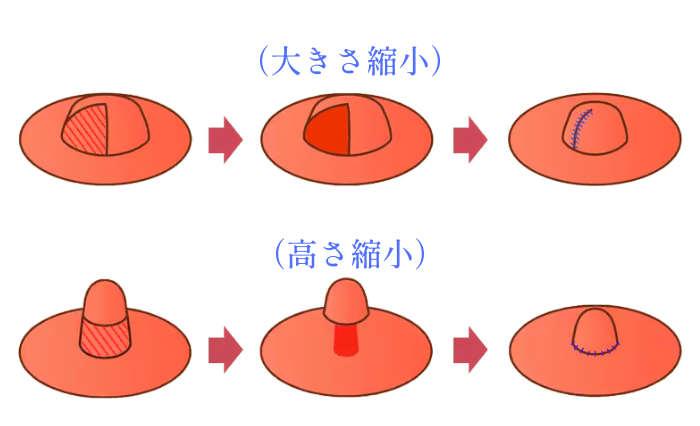 ♦︎乳頭縮小術って何？♦︎