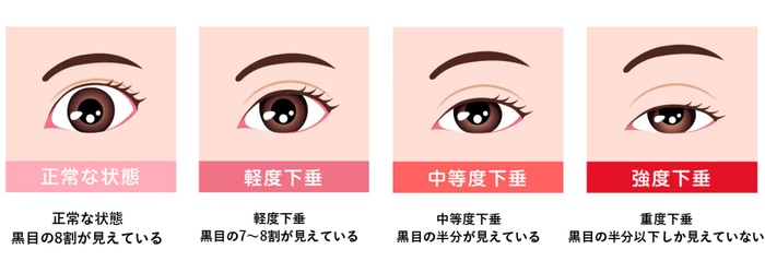 そもそも眼瞼下垂ってなに？