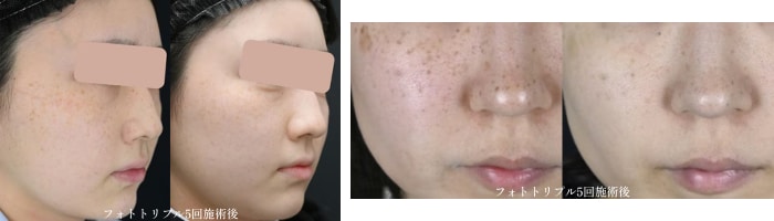 シミ・そばかす・くすみ・赤みが気になる方→フォトダブル／フォトトリプル