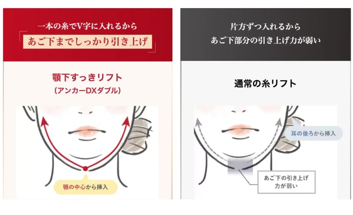 顎下専用の糸リフト