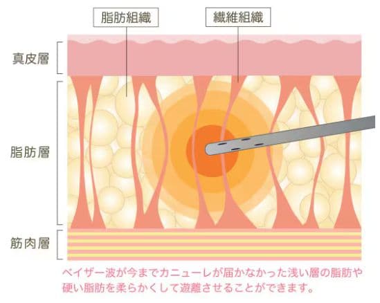 高い脂肪除去率と部分痩せ効果