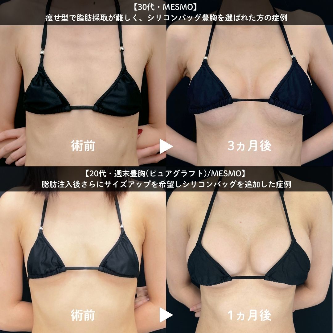 シリコンバッグ豊胸