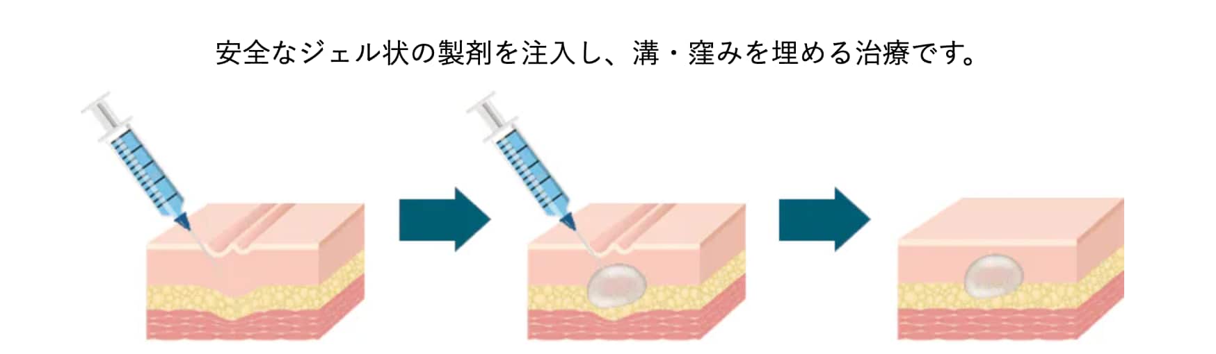 ヒアルロン酸注入とはどのような施術か