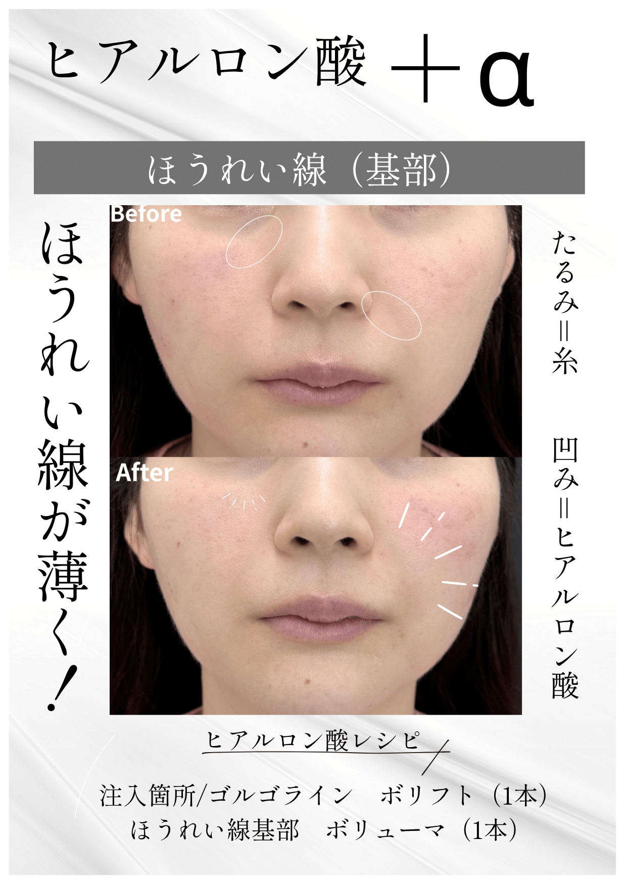ほうれい線の改善は糸が必要ってほんと？