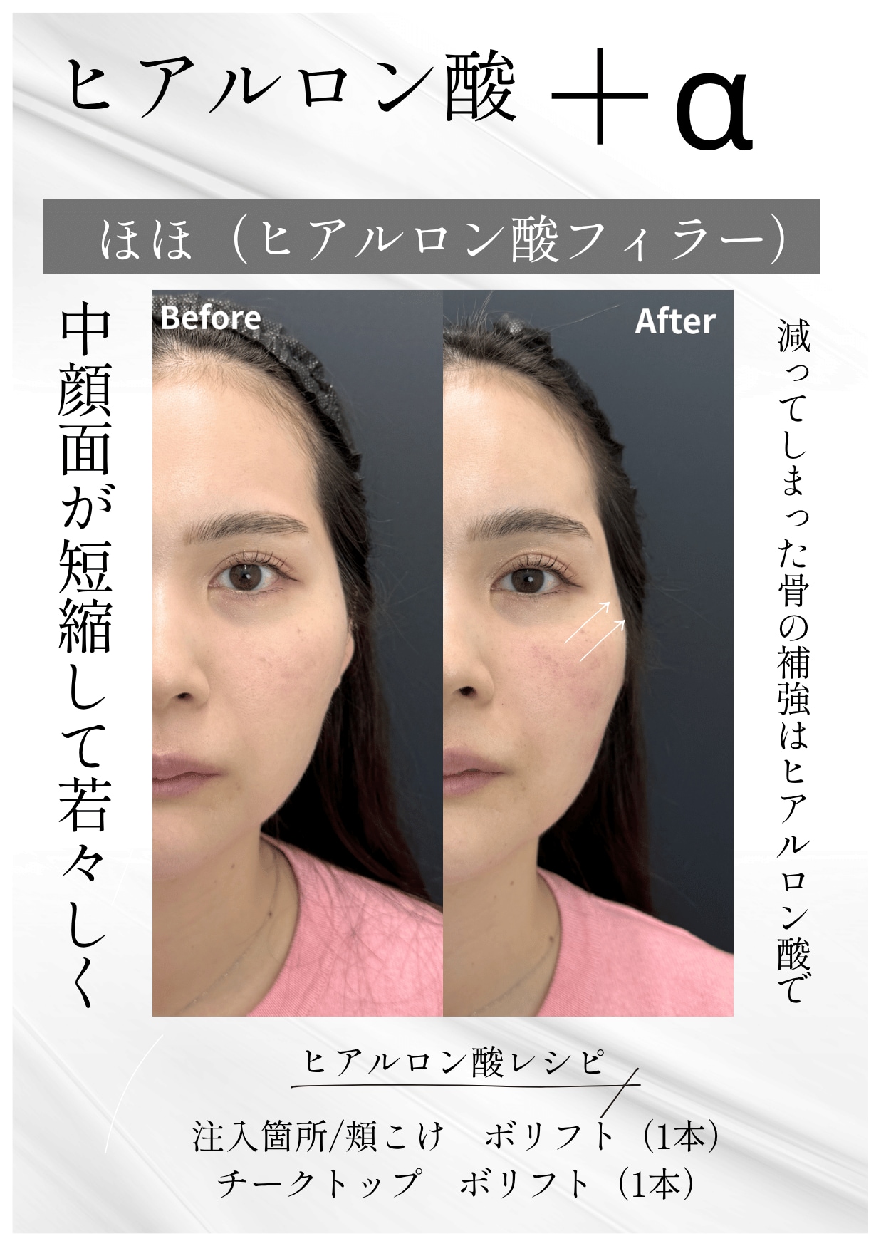 頬・頬こけの改善