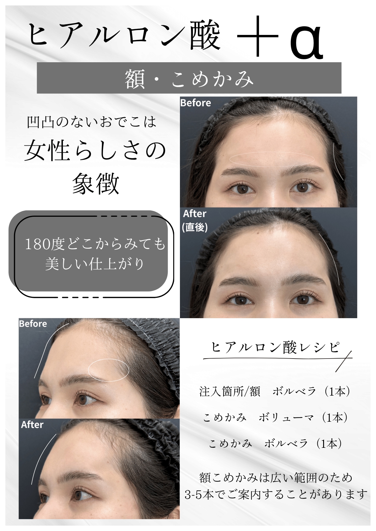 額・こめかみのヒアルロン酸