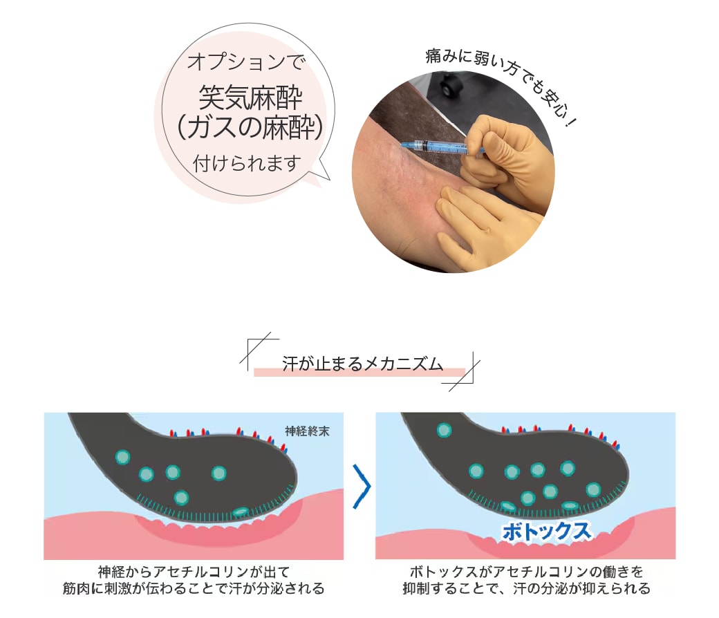 汗止め注射とは？わき汗を「止める」メカニズム