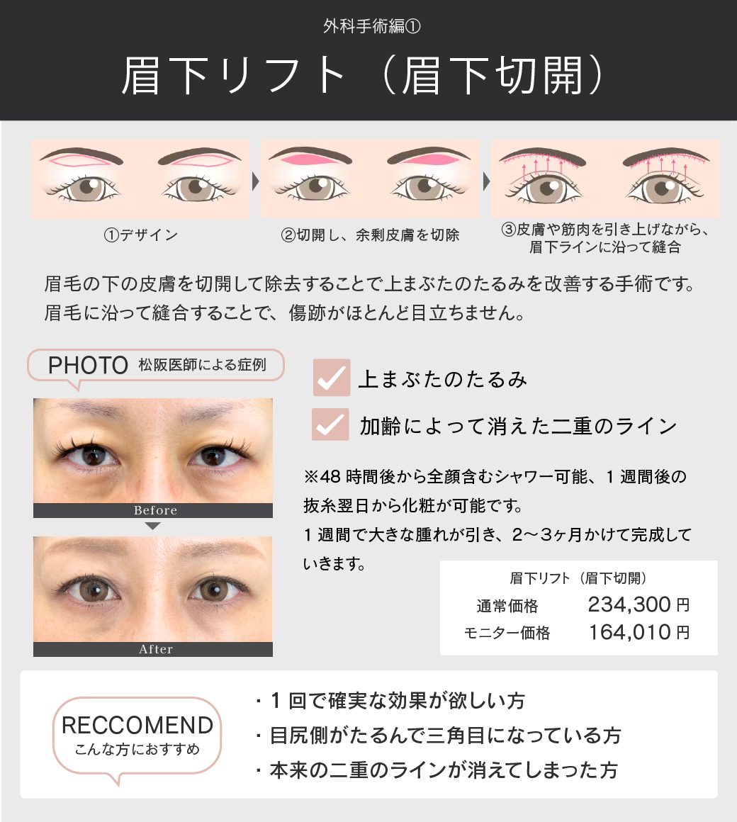 眉下リフト（眉下切開）とは？