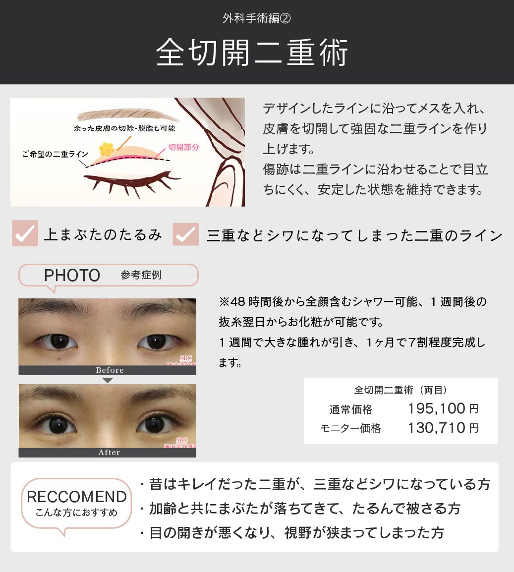 全切開二重術とは？