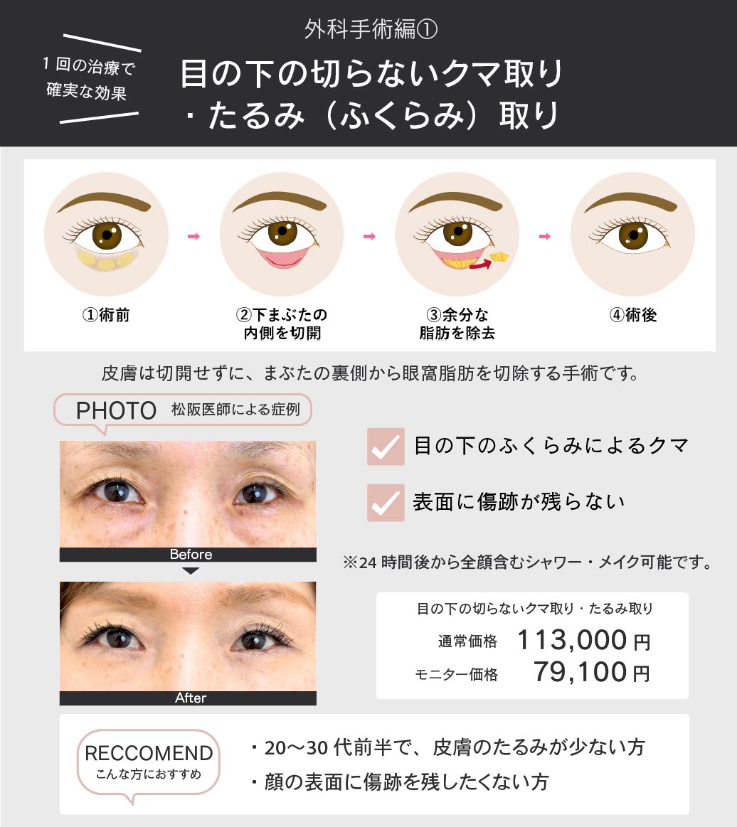 目の下の切らないクマ取り ・たるみ(ふくらみ)取りとは?
