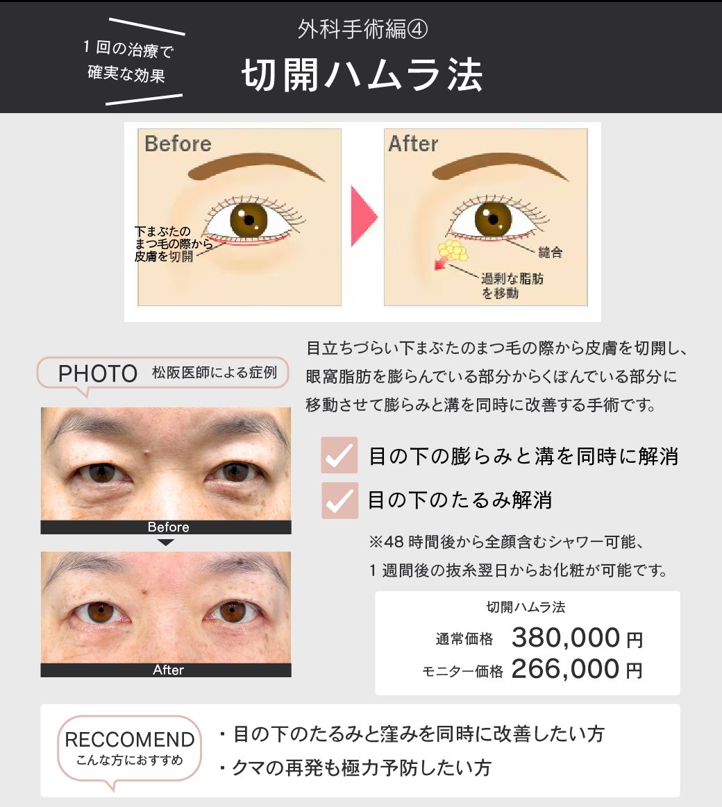 切開ハムラ法とは?