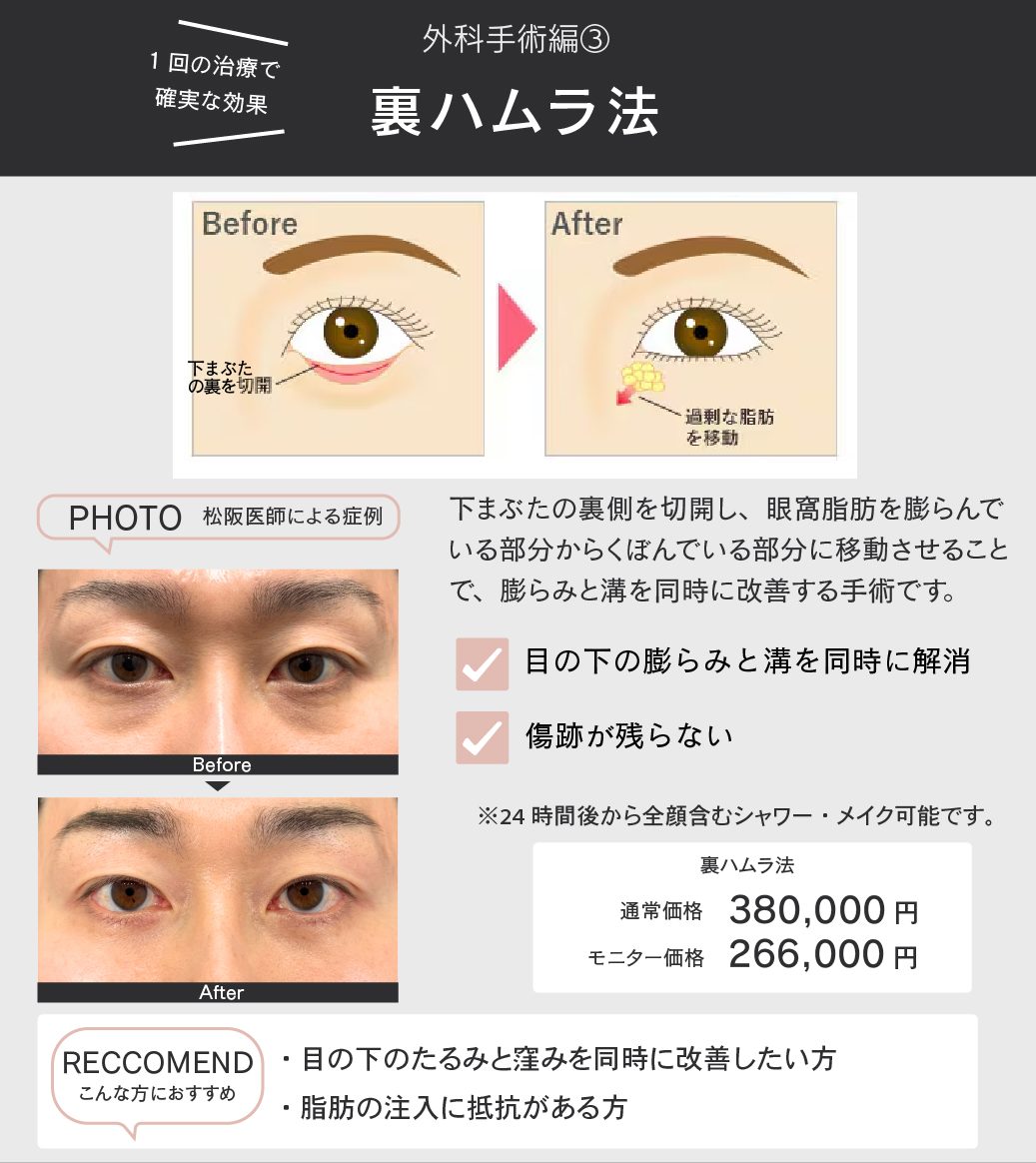 裏ハムラ法とは?