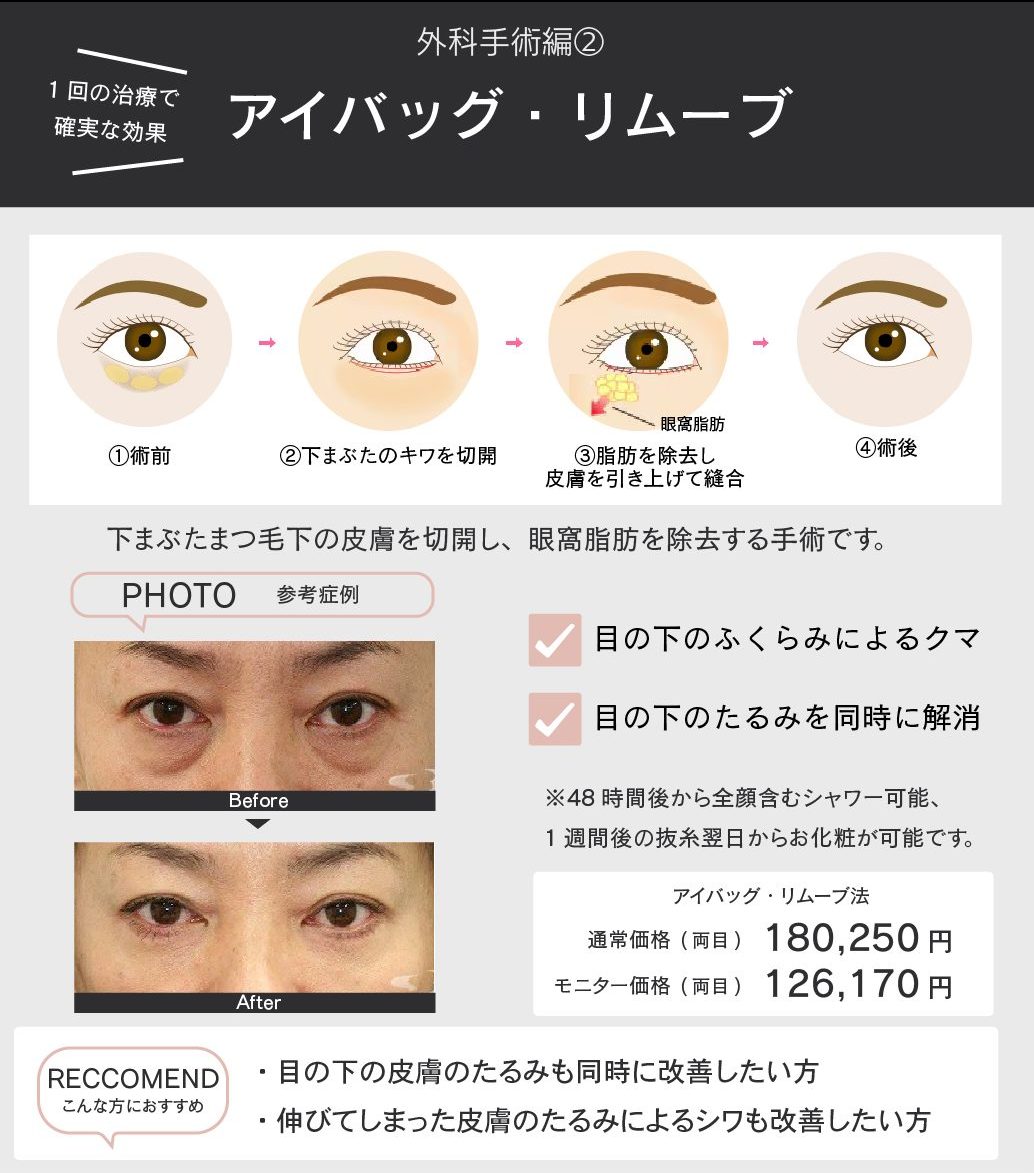 アイバッグ・リムーブ法とは?