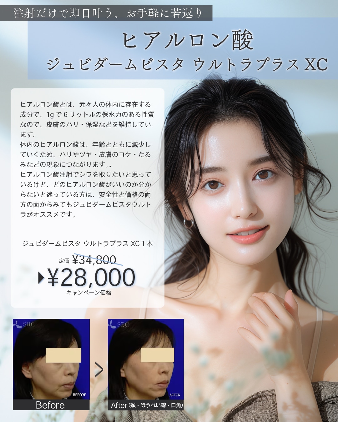 ヒアルロン酸【ジュビダームビスタ ウルトラリフトプラスXC】