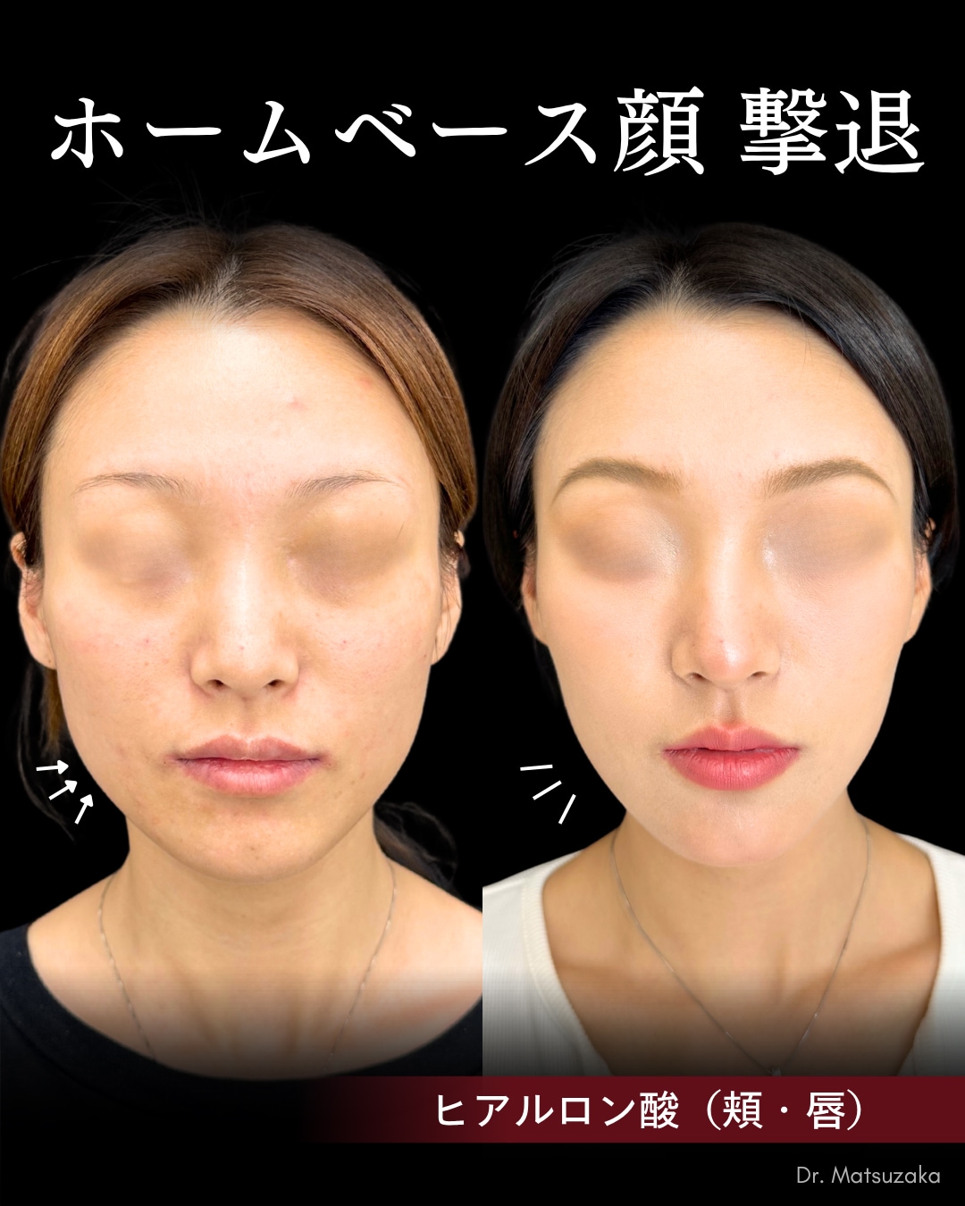 【ホームベース顔撃退】その悩み、原因はエラだけじゃないかも？