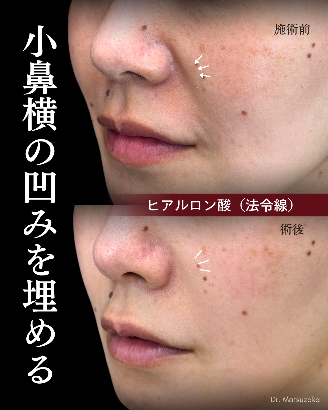 【貴族ヒアル（ほうれい線）】注射だけで手に入れる、洗練された品格フェイス。