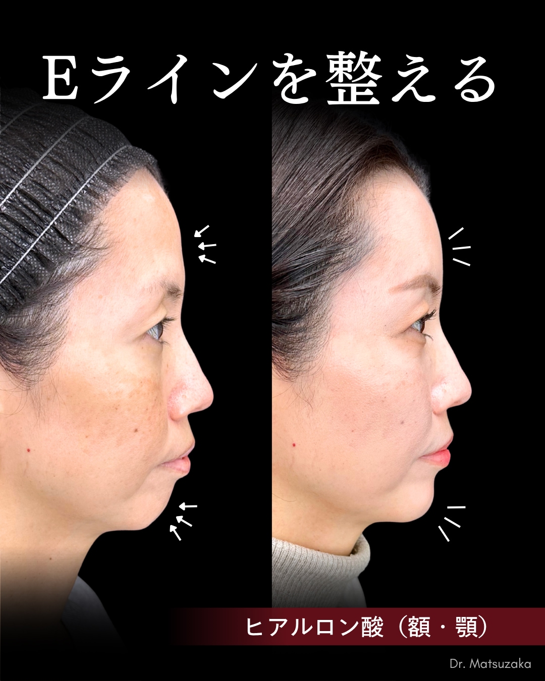 【横顔美人を創る】秘訣は「額とアゴ」にあり。最強のEライン注入。
