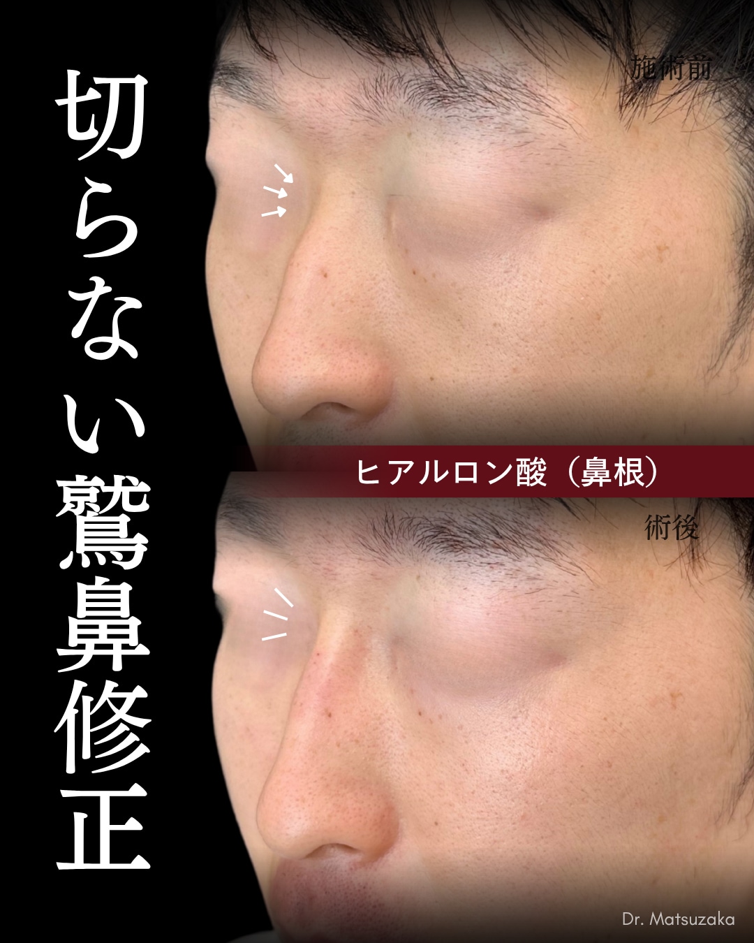 【もう削らない】注射だけで叶える、滑らかなストレート鼻筋へ。