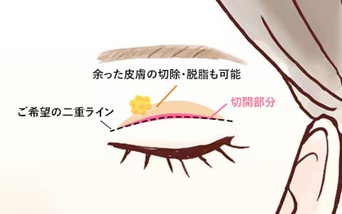 埋没法では取れてしまうトラブルも…