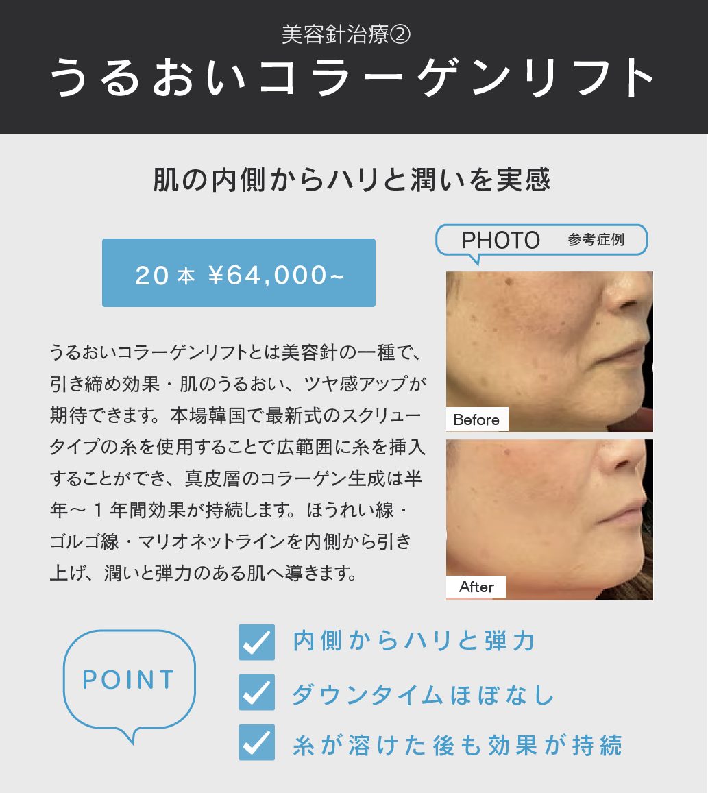 うるおいコラーゲンリフトとは？