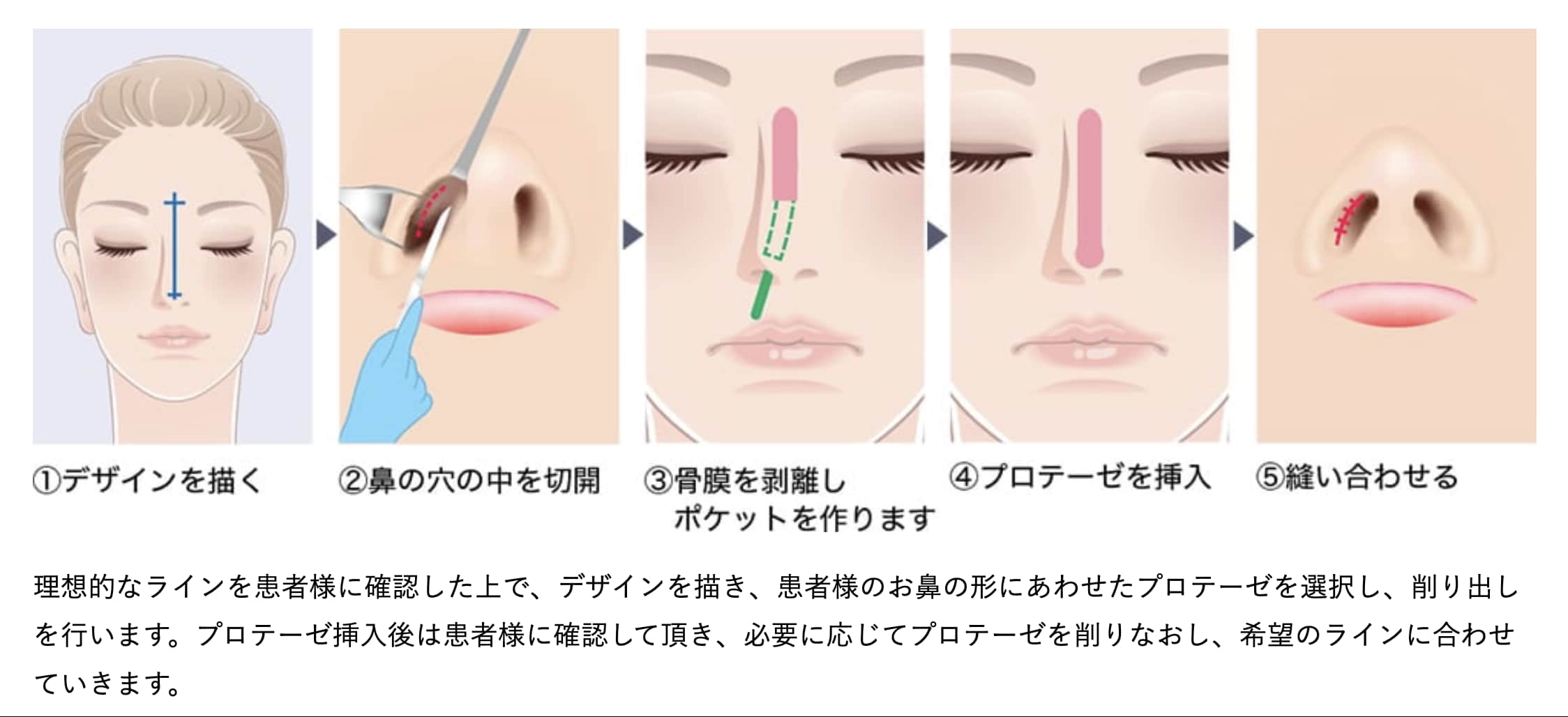 鼻筋を通し、メリハリのある顔立ちへ