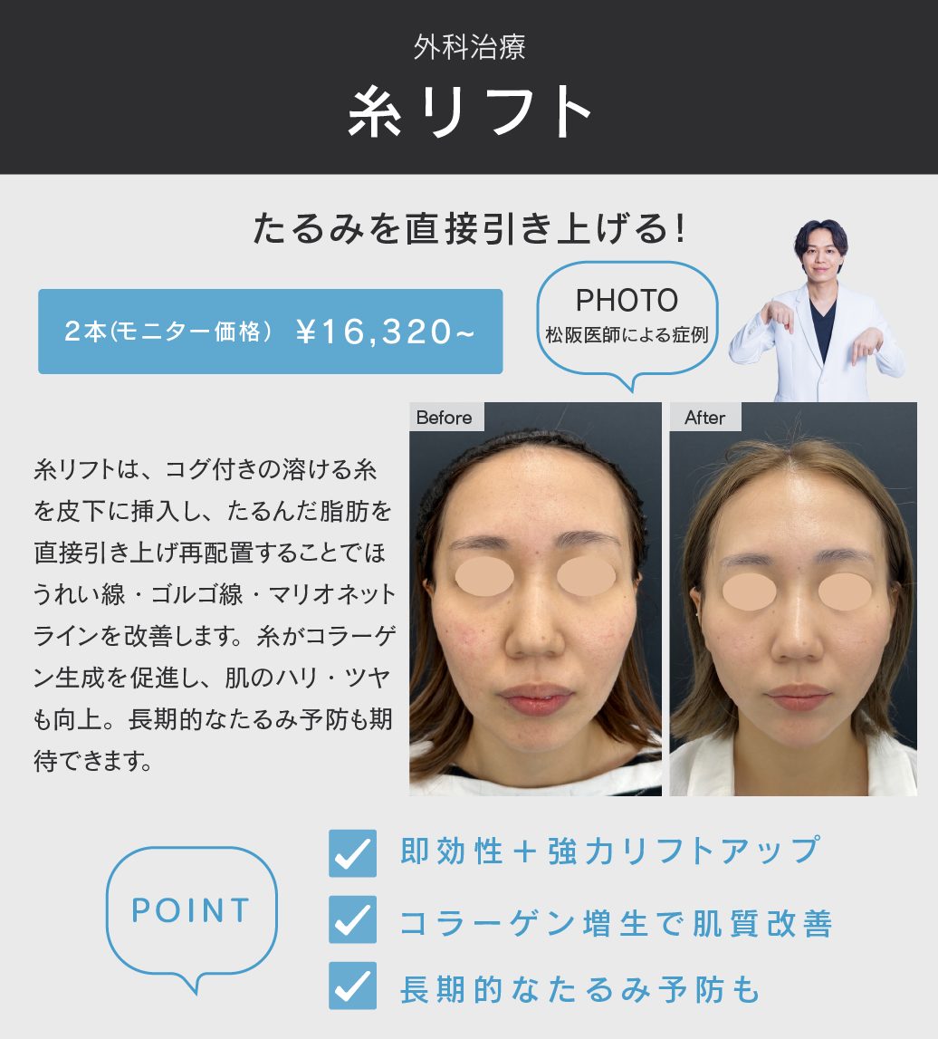 糸リフトとは？