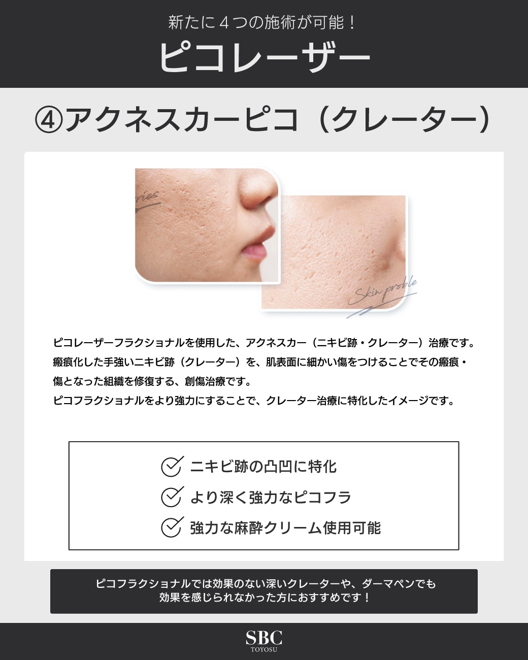 ニキビ跡の凸凹に特化