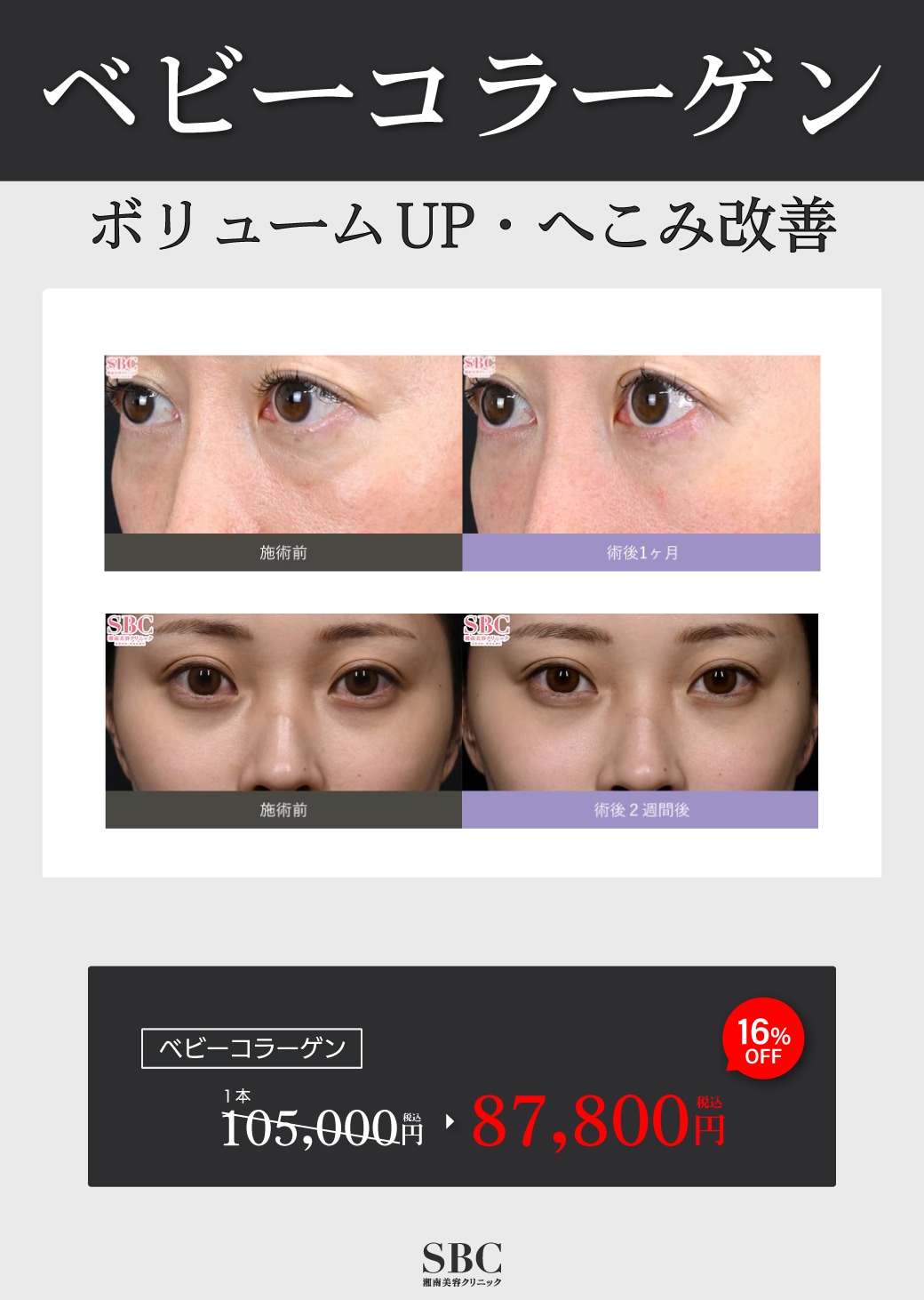 ボリュームUP・へこみ改善