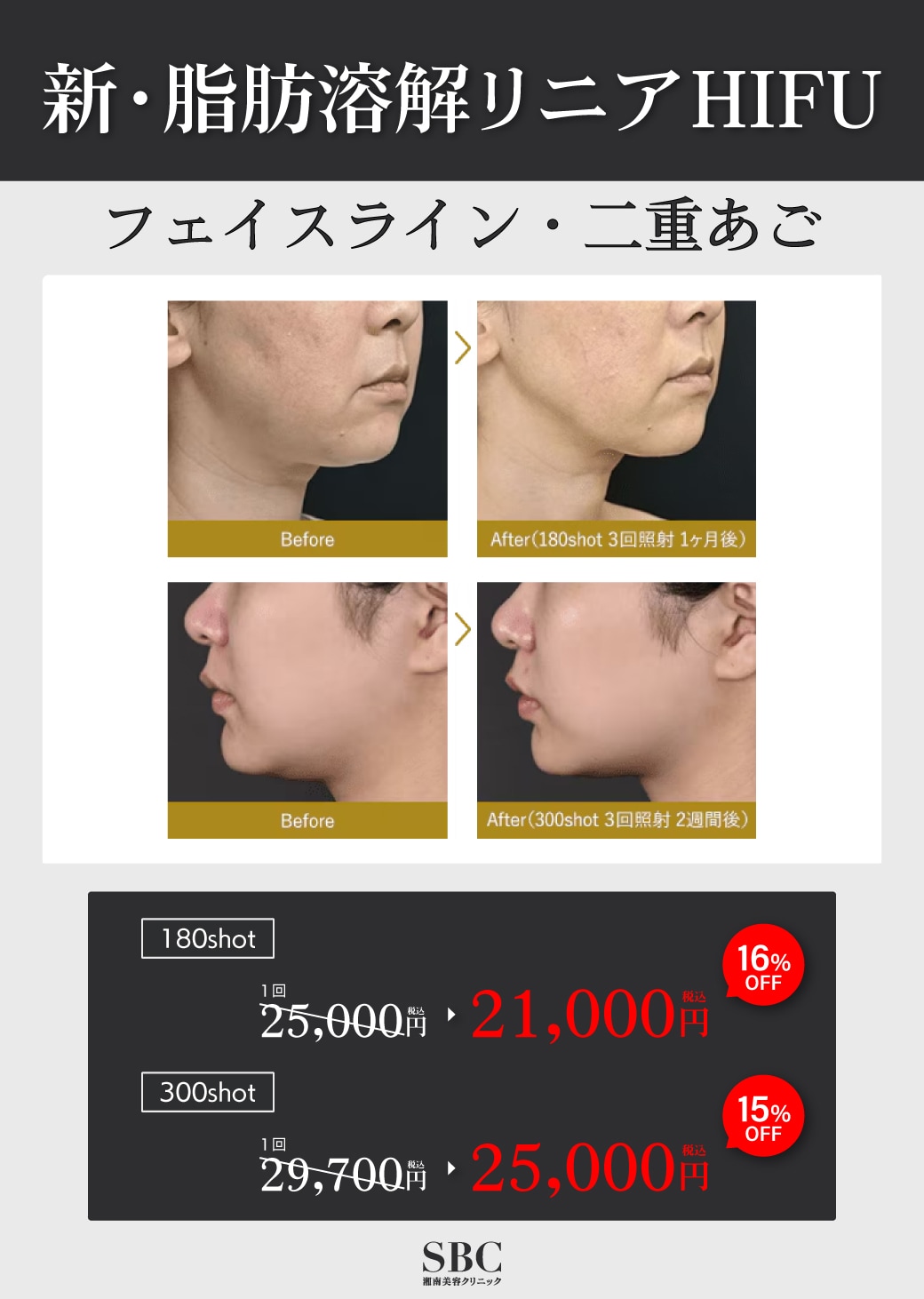フェイスライン・二重あご