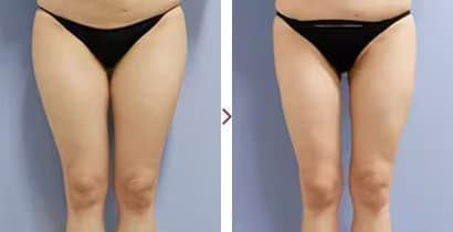 気になる下半身の脂肪を吸引！脱・洋ナシ体型